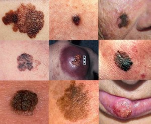 melanoma