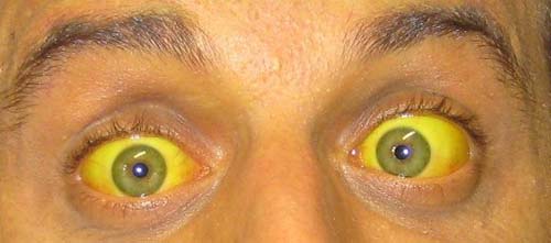 causas_problemas_figado_3