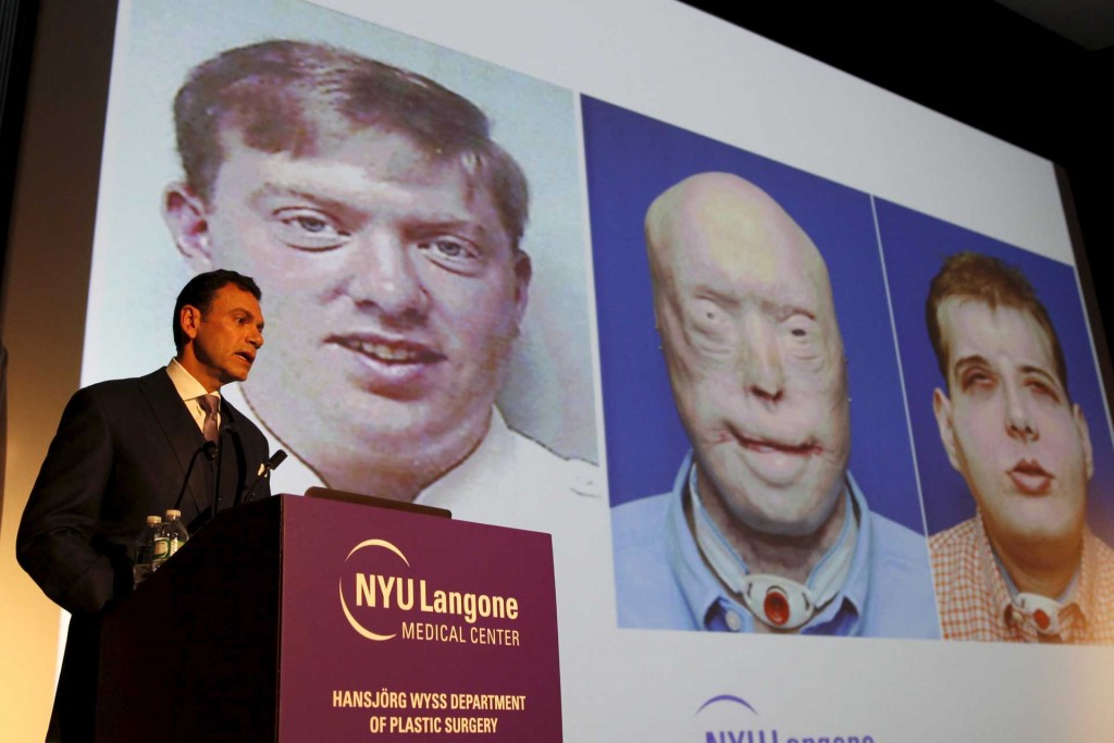 Dr. Eduardo D. Rodriguez, the Helen L. Kimmel Professor of Reconstructive Plastic Surgery at NYU Langone Medical Center holds a news conference to announce the successful completion of the most extensive face transplant to date in the Manhattan borough of New York City, November 16, 2015. Dr. Rodriguez led the surgical team on 41-year-old Patrick Hardison, a firefighter from Senatobia, Misissippi who's face was badly burned in 2001. More than 100 doctors and support staff took part in the 26-hour operation, conducted in August 2015 at the NYU Langone Medical Center. REUTERS/Mike Segar TPX IMAGES OF THE DAY
