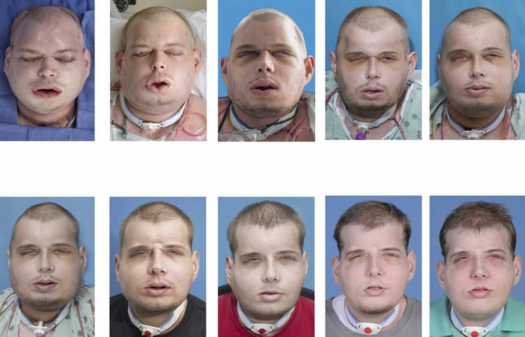 Volunteer firefighter Patrick Hardison, 41, of Senatobia, Mississippi is shown in this series of photos showing the progress of face transplant surgery in this undated handout provided by NYU Langone Medical Center in New York, November 16, 2015. Hardison, whose face was burned off during a rescue is the recipient of what surgeons called the most extensive face transplant ever, performed at a New York hospital. REUTERS/NYU Langone Medical Center/Handout via Reuters ATTENTION EDITORS - NOT FOR SALE FOR MARKETING OR ADVERTISING CAMPAIGNS. THIS IMAGE HAS BEEN SUPPLIED BY A THIRD PARTY. IT IS DISTRIBUTED, EXACTLY AS RECEIVED BY REUTERS, AS A SERVICE TO CLIENTS. EDITORIAL USE ONLY. NO RESALES. NO ARCHIVE