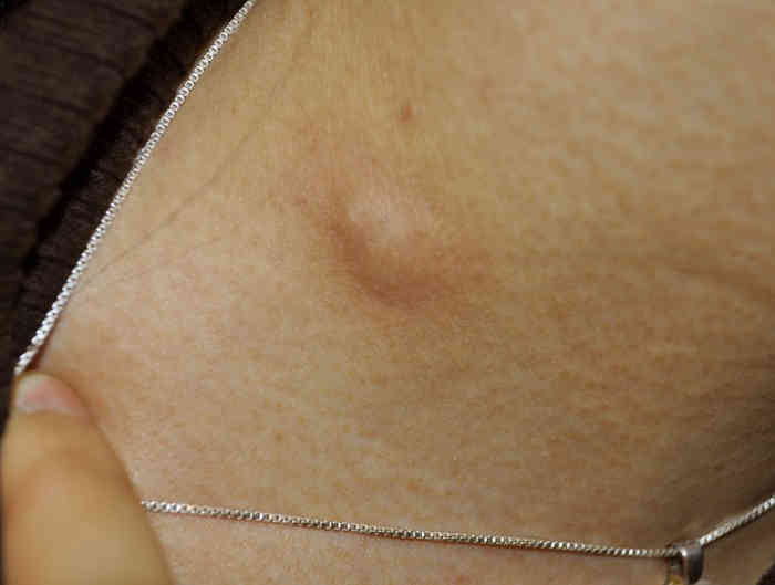 armpit-cyst-pictures-2