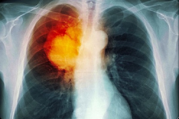 lung-cancer-s5-lung-cancer-xray